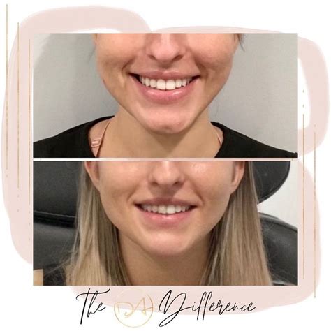 This Beautiful Patient Had A Naturally Dimpled Chin That She Wanted