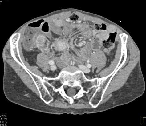 Metastatic Carcinoid Tumor To The Liver And Bowel And Mesentery Small