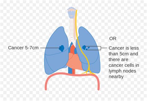 Diagram Showing Stage 2a Lung Cancer Cruk 213 Lung Cancer Stages