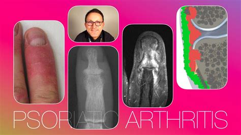 Psoriatic Arthritis How X Rays And Mri Perform In Diagnosing The