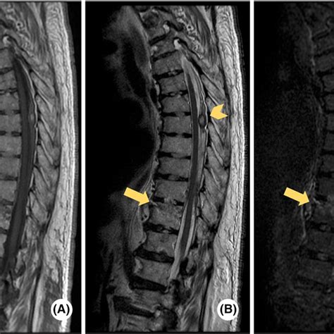 Spinal Magnetic Resonance Imaging Mri On Day 3 Thoracic Vertebral