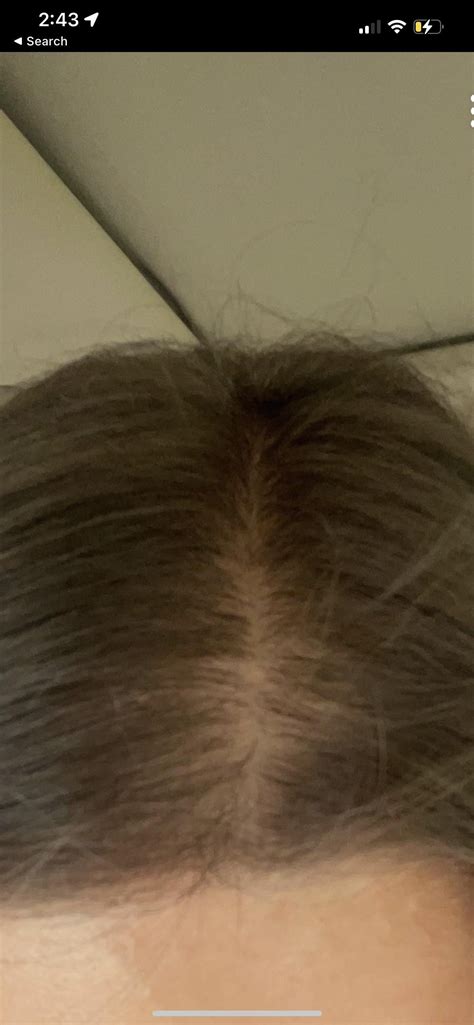 Is this shedding normal for topical minoxidil 2% or should I stop now