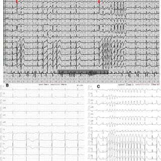 Changes In ECG During Treatment A Holter On Admission Showed R On T