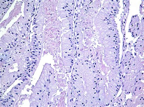 Pathology Outlines Villous Adenocarcinoma Of Colon