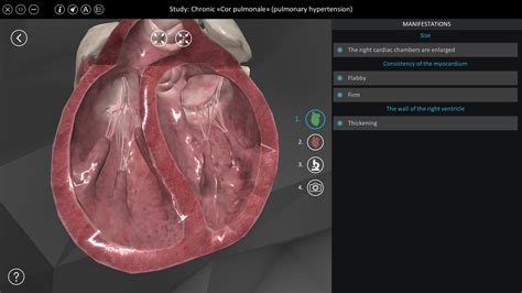 Chronic "Cor pulmonale" (pulmonary hypertension) | ROQED