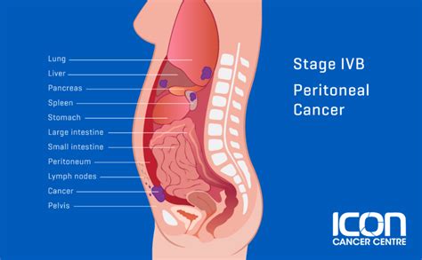 What Is Peritoneal Cancer Peritoneal Cancer Explained Icon Cancer Centre