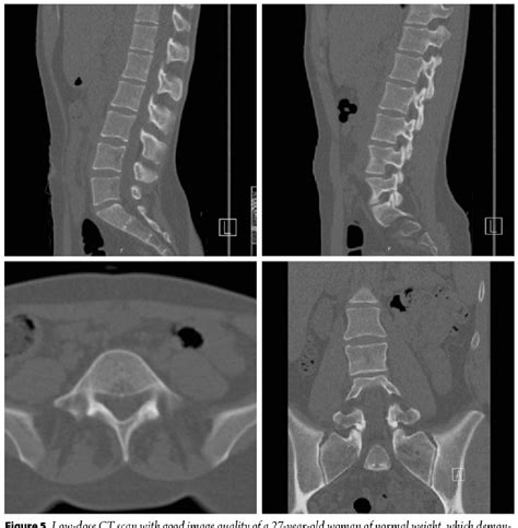 PDF Computed Tomography Of Thoracolumbar Spine Trauma Semantic Scholar