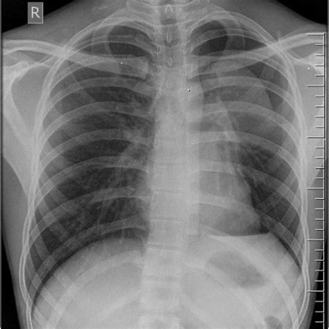 CT Thorax Showing Left Upper Lobe Congenital Lobar Emphysema CLE With