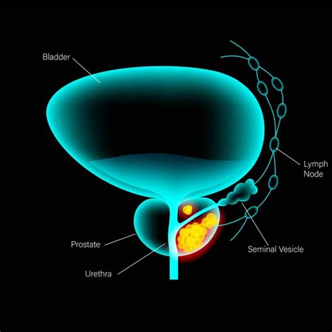 Prostate Cancer Infographic Vector Art Stock Images Depositphotos