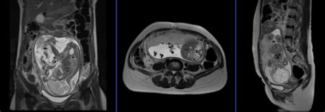 Fetal Brain MRI | Fetal Brain Scan Protocol and Planning