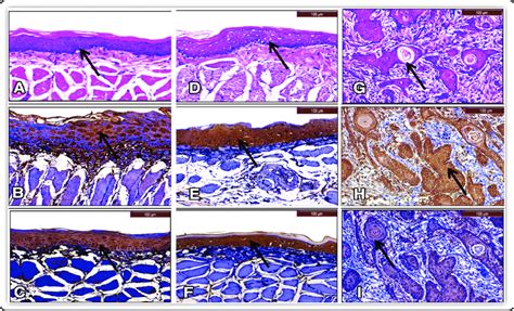 A H E Stain Of Giiia Of Hbp Mucosa Showing Mild Epithelial Dysplasia