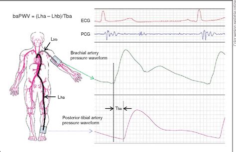 Figure 1 From Brachial Ankle Pulse Wave Velocity Myths Misconceptions