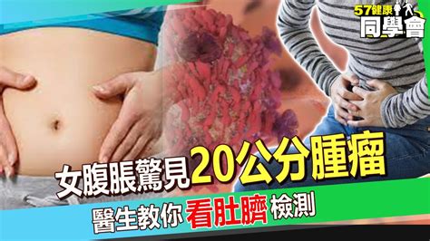 【精選】50歲媽腹痛腹脹驚見20公分腫瘤！7成卵巢癌末期才發現？！醫生教你1招看肚臍檢測！【 57healthy 】 Youtube