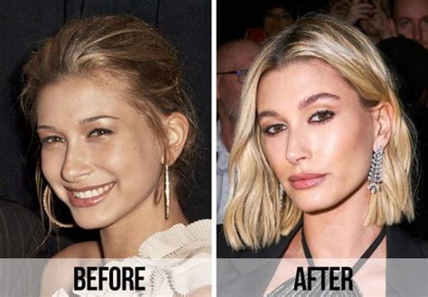 Hailey Bieber Plastic Surgery Fact Or Fiction