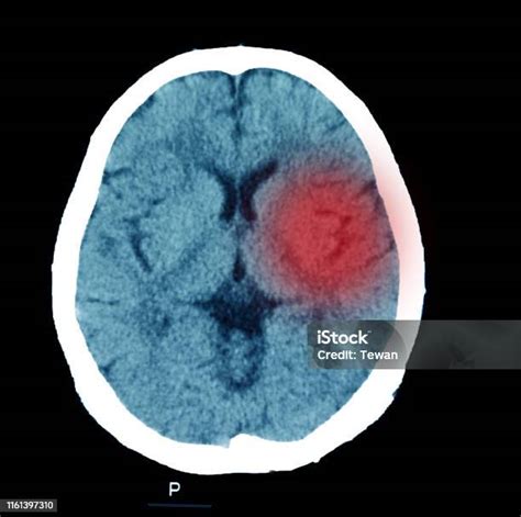 Tomografía Computarizada Del Cerebro Accidente Cerebrovascular