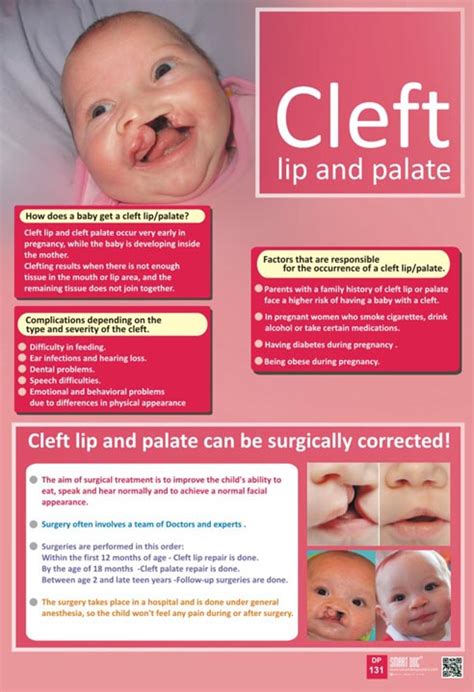 Cleft Lip Palate Eng DP 131 Smart Doc Posters