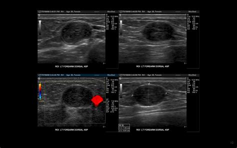 Lump In Forearm For Some Years Recent Rapid Growth Ganglion Malignancy Usg A Photo On