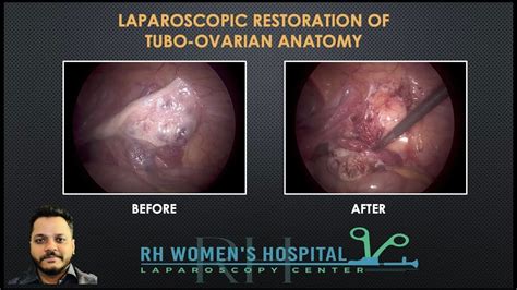 Laparoscopic Restoration Of Tubo Ovarian Anatomy Youtube