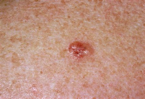 Skin Cancer Warning Signs What Skin Cancer Looks Like