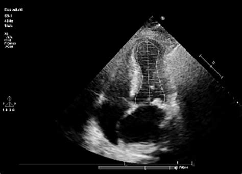 End Diastolic Left Ventricular Volume Figure 3 End Systolic Left Download Scientific Diagram