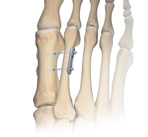 Arthrex Mini TightRope Technique For Hallux Valgus