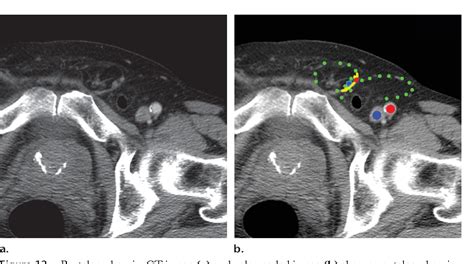 Inguinal Hernia Radiology