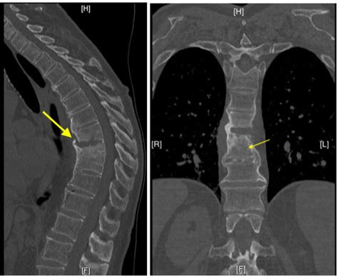 Osteomyelitis X Ray Spine