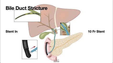 Hcc 1474 17c Plastic Stents 10fr Youtube