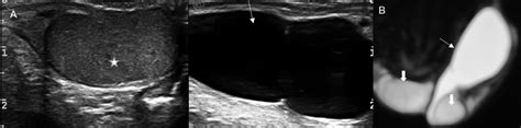 A Spermatic Cord Cyst Split Screen Gray Scale Us Shows The Normal