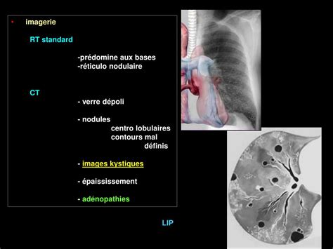 Ppt Le Syst Me Lymphatique Du Parenchyme Pulmonaire Et Sa Pathologie