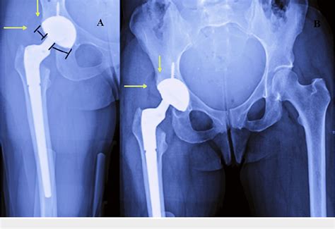 Figure From A Missed Diagnosis Of Intraprosthetic Dislocation In A