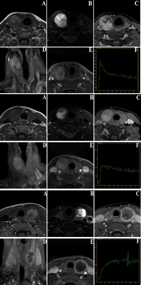 The Diagnostic Value Of Dynamic Contrast Enhanced Mri For Thyroid