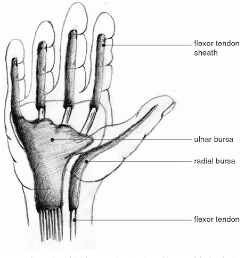 Flexor Tendon Tenosynovitis