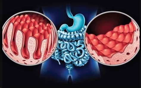 The Causes and Consequences of Malabsorption, as Well as a Simple Way ...