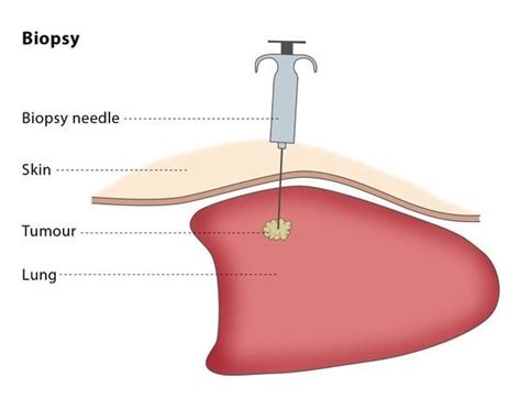 Biopsy Cirse