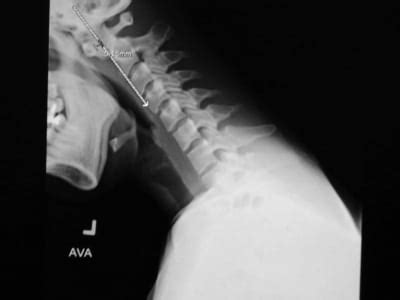 Os Odontoideum: Rare Cervical Lesion - The Western Journal of Emergency ...