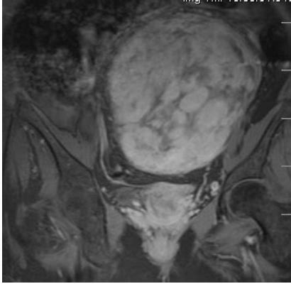 Figure From Giant Retroperitoneal Presacral Ancient Schwannoma