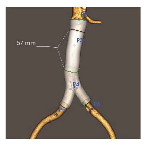 Treatment Of The Infrarenal Aortic Dissection Using The Endologix AFX