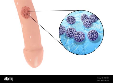 Verrugas Del Pene Genitales Y Vista De Cerca Del Virus Del Papiloma