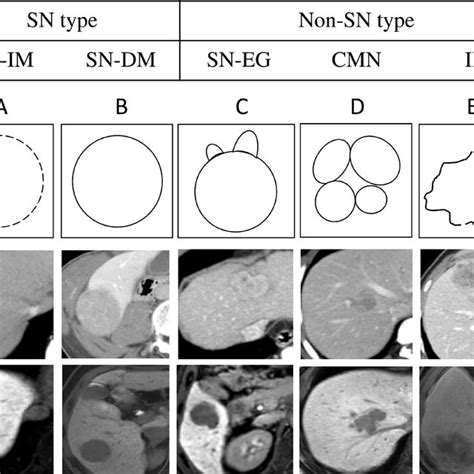 Summaries Of The Five Gross Classification Of Hepatocellular Carcinoma Download Scientific