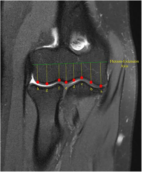 A Comprehensive Coronal And Axial Bone Dimension And Cartilage