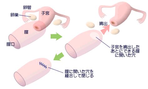 子宮を全摘出するとどうなる？ 前向きに！