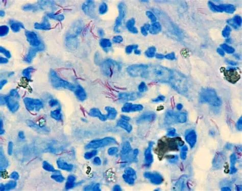 Mycobacterium Leprae Acid Fast