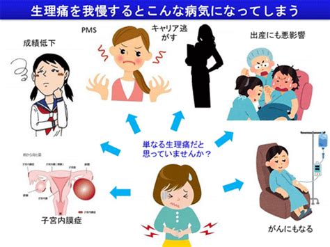 子宮内膜症（卵巣がんとの関係について） 公益社団法人 日本婦人科腫瘍学会