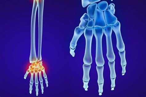 Causes Symptoms And Treatments Of A Scaphoid Fracture Health