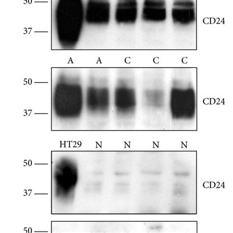 Expression Of Cd24 In Peripheral Blood Cell Lysates From Adenoma Crc