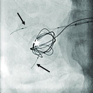 Fluoroscopic Spot Image In The Year Old Male Patient Showing The