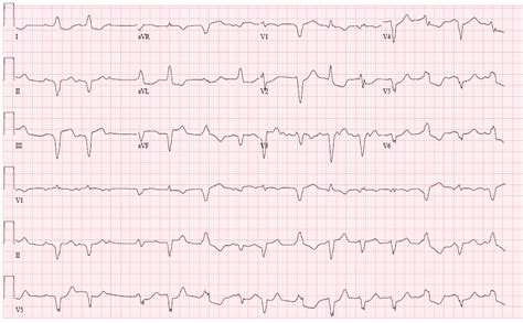 Autoimmune Myocarditis With Av Block Too Much Of A Good Thing