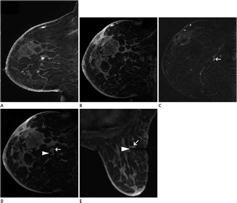 Breast Magnetic Resonance Imaging Guided Biopsy