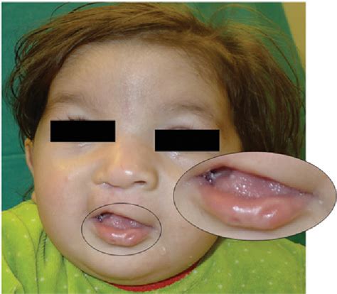 Figure From Prenatal Diagnosis And Management Of Van Der Woude